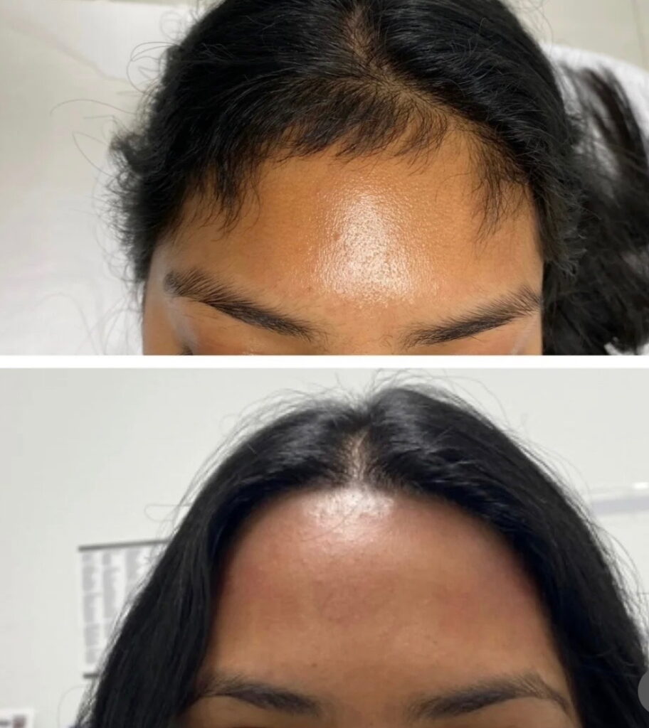 Before and after image of woman's forehead hairline,.